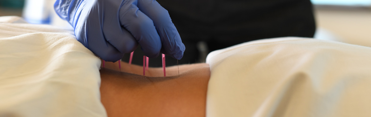 physical therapy applies dryneedling treatment at mercy health