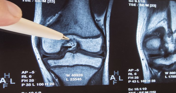 Person's finger and pen pointing at films evaluating possible partial joint replacement