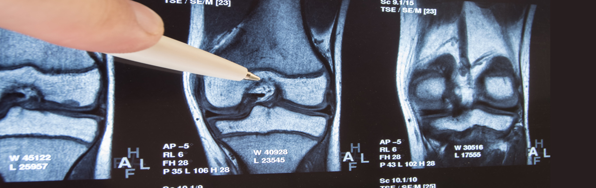 Person's finger and pen pointing at films evaluating possible partial joint replacement