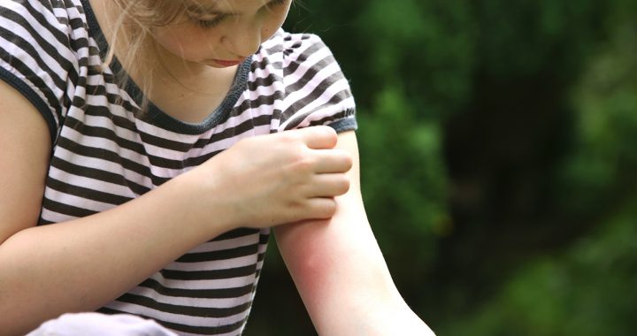 A woman with a bug bite on her arm.